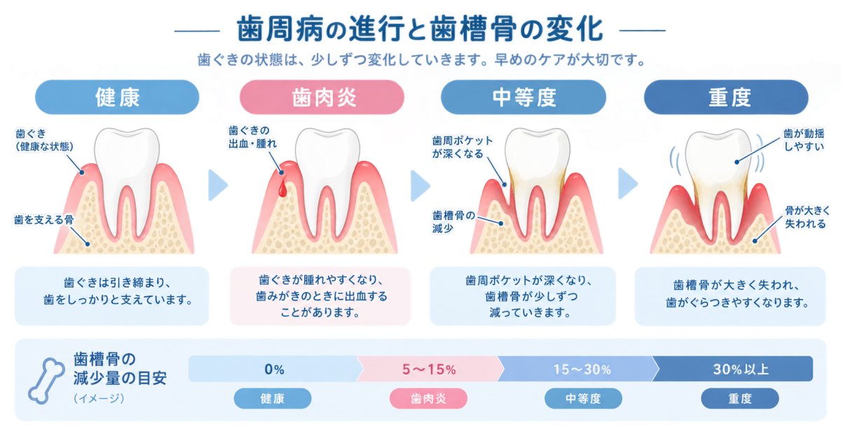 歯茎の出血・腫れは今どの段階？歯周病放置で歯を失う前にできること
